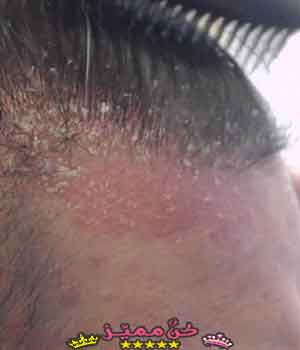 مرض يصيب فروة شعر الإنسان