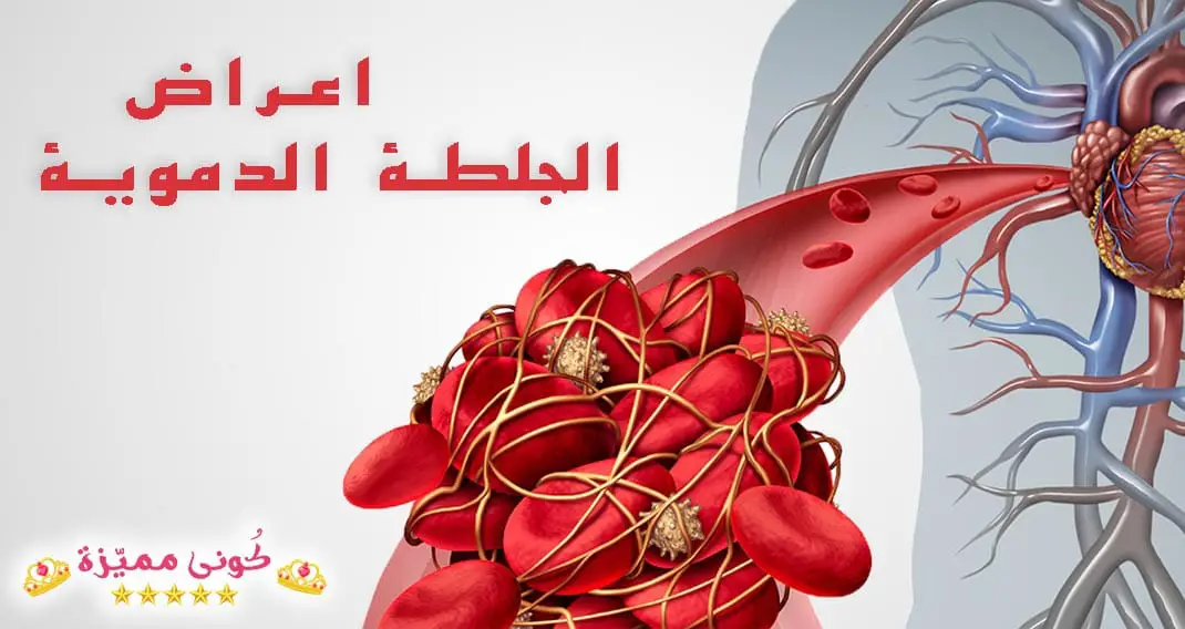 اعراض الجلطة الدموية في الساق و الرئة و الدماغ طرق العلاج و الاسباب