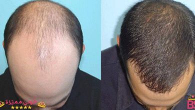 زراعة الشعر فى الاسكندرية