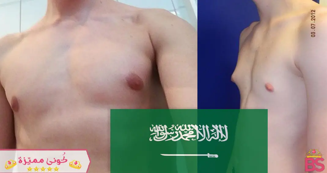 عملية ازالة التثدي عند الرجال فى السعودية