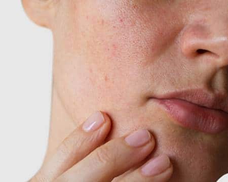 علاج تهيج الحصوات بعد الحلاقة بالميكروويف للنساء Alsanapropertyinvestments Com