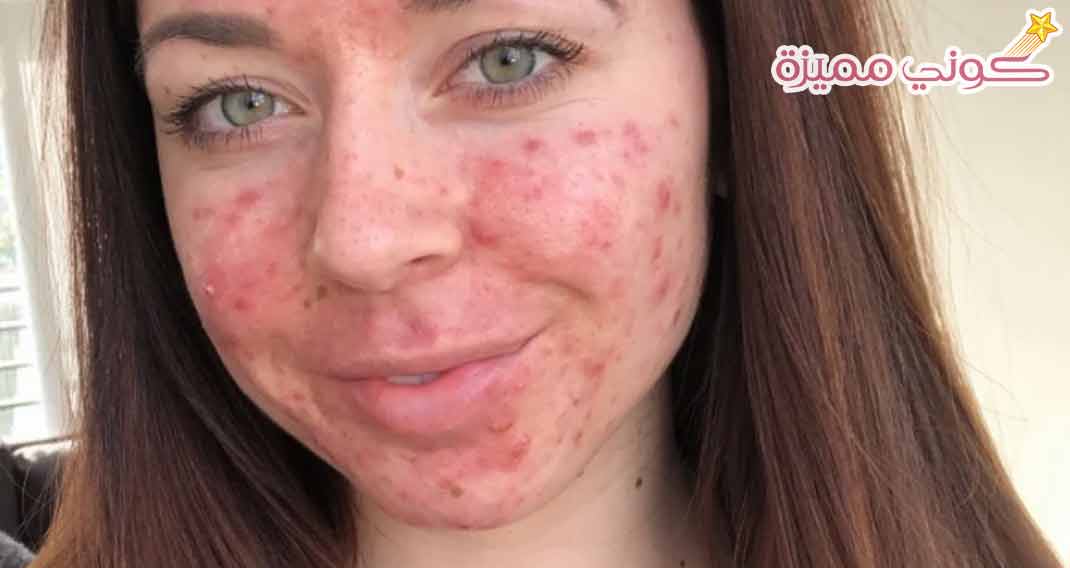 اسباب ظهور حب الشباب وتجارب الاشخاص مع علاجها كوني مميزة