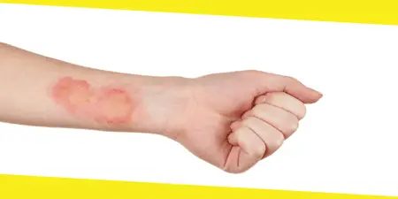 علاج حروق الماء الساخن
