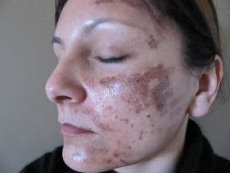 حروق الليزر هل تختفي؟